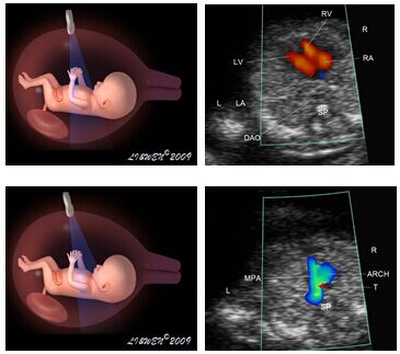 胎儿心脏彩超